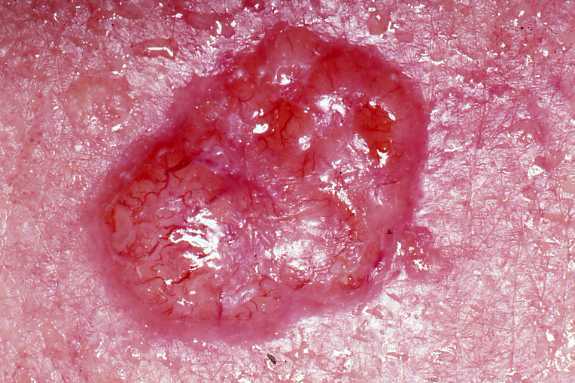 Basal cell carcinoma is the most common skin cancer