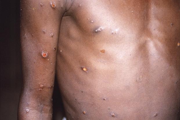 The right arm and torso of a patient overseas whose skin displays a number of lesions due to what had been an active case of monkeypox (CDC via AP)